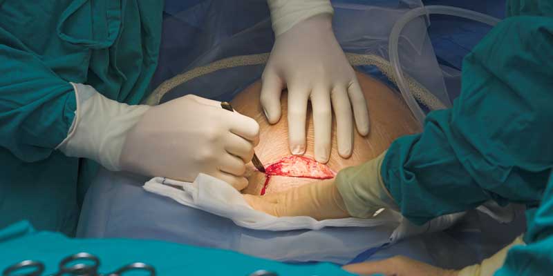 Birthing by the Clock: What is the BTS of increased C-section births in India?